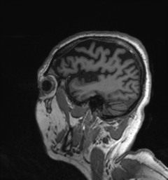 File:Behavioral variant frontotemporal dementia and late onset schizophrenia (Radiopaedia 52197-58083 Sagittal T1 8).png