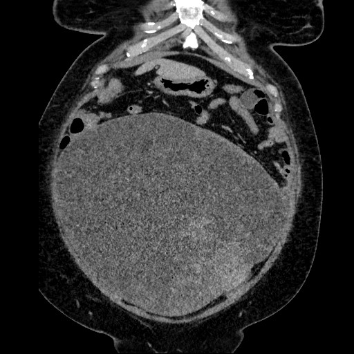 Benign leiomyoma with hydropic features (Radiopaedia 89250-106130 B 40).jpg