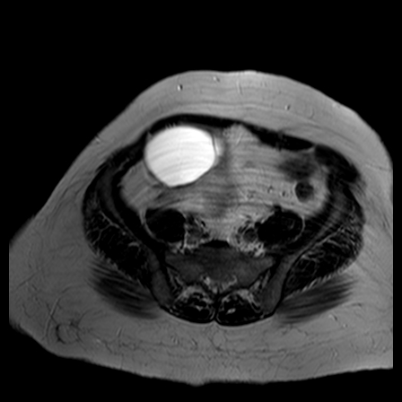 File:Benign seromucinous cystadenoma of the ovary (Radiopaedia 71065-81300 B 14).jpg