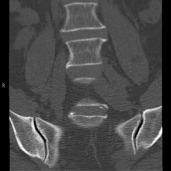 Bertolotti syndrome (Radiopaedia 24864-25128 Coronal bone window 11).jpg