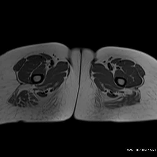 File:Bicornuate uterus- on MRI (Radiopaedia 49206-54297 Axial T1 21).jpg
