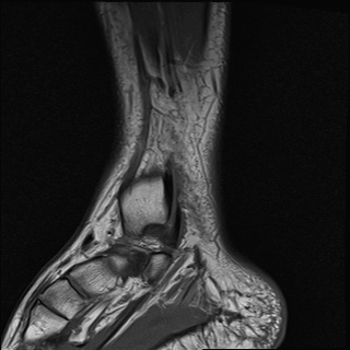 File:Bilateral Achilles tendon complete tear (Radiopaedia 81344-95051 Sagittal T1 17).jpg