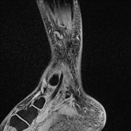 Bilateral Achilles tendon complete tear (Radiopaedia 81344-95051 Sagittal WE - Left 30).jpg