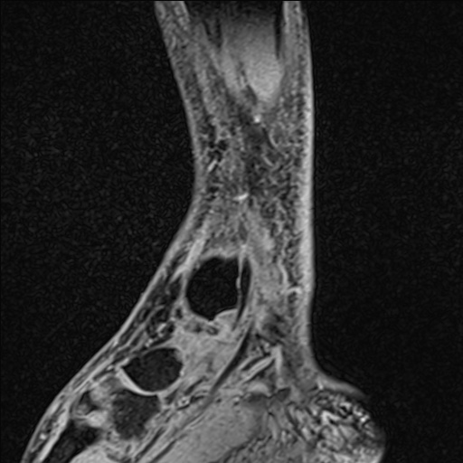 Bilateral Achilles tendon complete tear (Radiopaedia 81344-95051 Sagittal WE - Right 84).jpg