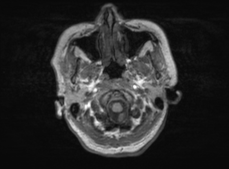 File:Bilateral PCA territory infarction - different ages (Radiopaedia 46200-51784 Axial T1 348).jpg