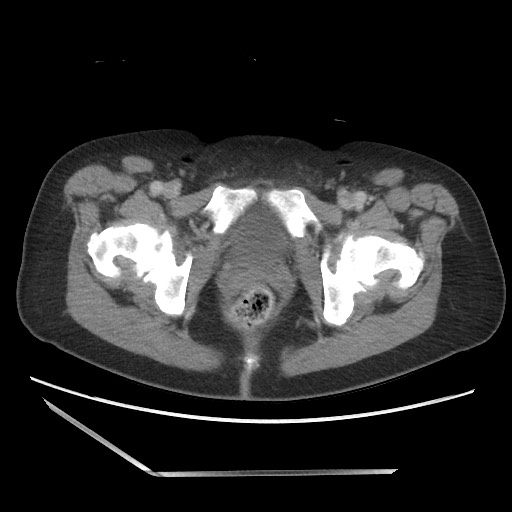 Bilateral adrenal granulocytic sarcomas (chloromas) (Radiopaedia 78375-91007 A 118).jpg