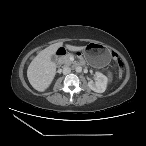 Bilateral adrenal granulocytic sarcomas (chloromas) (Radiopaedia 78375-91007 A 53).jpg