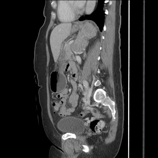Bilateral adrenal granulocytic sarcomas (chloromas) (Radiopaedia 78375-91007 C 85).jpg