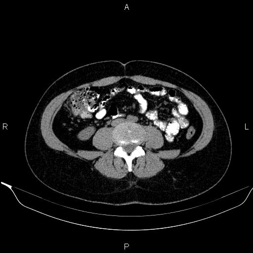 Bilateral adrenal myelolipoma (Radiopaedia 63058-71535 Axial non-contrast 105).jpg