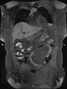 Bilateral adrenal myelolipoma (Radiopaedia 63058-71537 Coronal T1 fat sat 79).jpg