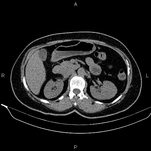 Bilateral benign adrenal adenomas (Radiopaedia 86912-103124 Axial non-contrast 44).jpg