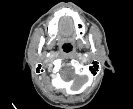 File:Bilateral carotid body tumors (Radiopaedia 61841-69870 Axial Post contrast 16).jpg