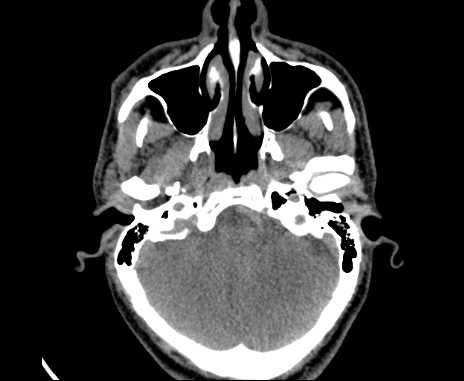 Bilateral carotid body tumors (Radiopaedia 61841-69870 Axial non-contrast 4).jpg