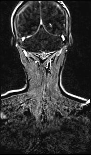 File:Bilateral carotid body tumors and right glomus jugulare tumor (Radiopaedia 20024-20060 MRA 137).jpg