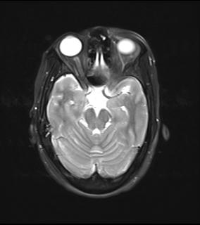 File:Bilateral carotid body tumors and right jugular paraganglioma (Radiopaedia 20024-20060 Axial 18).jpg