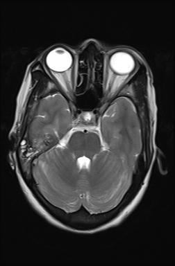 File:Bilateral carotid body tumors and right jugular paraganglioma (Radiopaedia 20024-20060 Axial 55).jpg