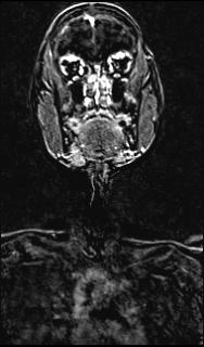 File:Bilateral carotid body tumors and right jugular paraganglioma (Radiopaedia 20024-20060 None 100).jpg