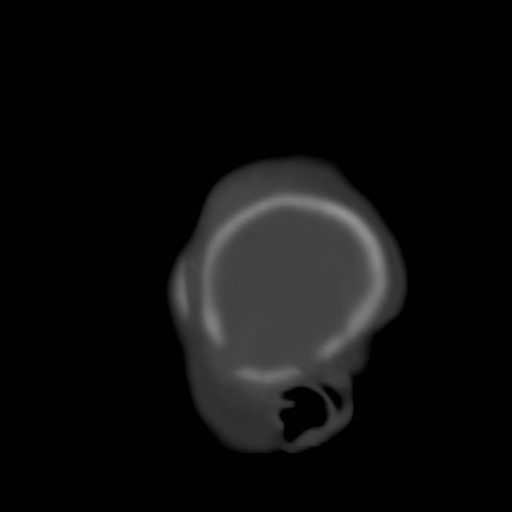 File:Bilateral cephalohematomas and subdural hematomas (Radiopaedia 26778-26929 Sagittal bone window 39).jpg