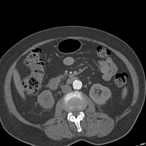 File:Bilateral delayed nephrogram from renal artery stenosis (Radiopaedia 47681-52362 A 28).png