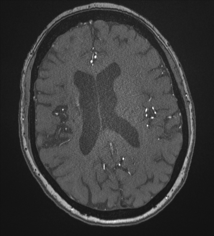 Bilateral fetal posterior communicating arteries (Radiopaedia 41286-44102 Axial MRA 135).png