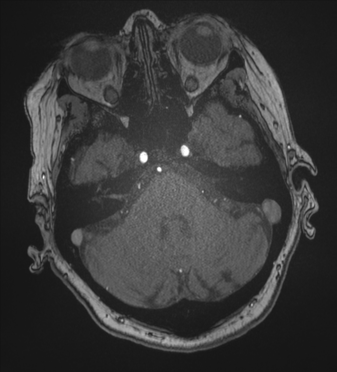 Bilateral fetal posterior communicating arteries (Radiopaedia 41286-44102 Axial MRA 44).png
