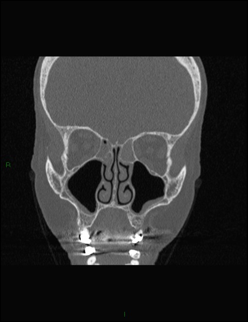 Bilateral frontal mucoceles (Radiopaedia 82352-96454 Coronal 144).jpg