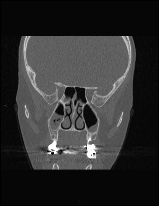 Bilateral frontal mucoceles (Radiopaedia 82352-96454 Coronal 181).jpg