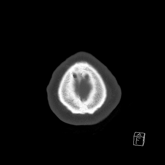 Bilateral occipital condyle fracture (type 2) (Radiopaedia 87675-104089 Axial bone window 117).jpg