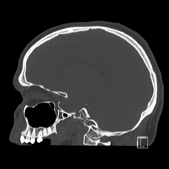 Bilateral occipital condyle fracture (type 2) (Radiopaedia 87675-104089 Sagittal bone window 39).jpg
