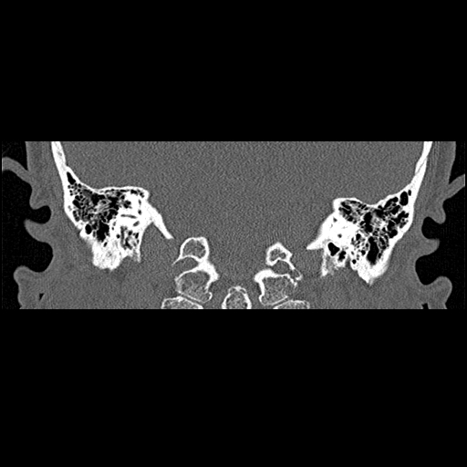 File:Bilateral ossifications of the external auditory canal (Radiopaedia 15233-15076 Coronal bone window 18).jpg