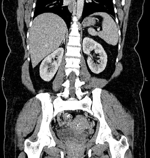 Bilateral ovarian dermoid cysts (Radiopaedia 85785-101603 C 38).jpg