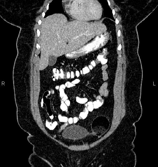 Bilateral ovarian dermoid cysts (Radiopaedia 85785-101603 C 9).jpg