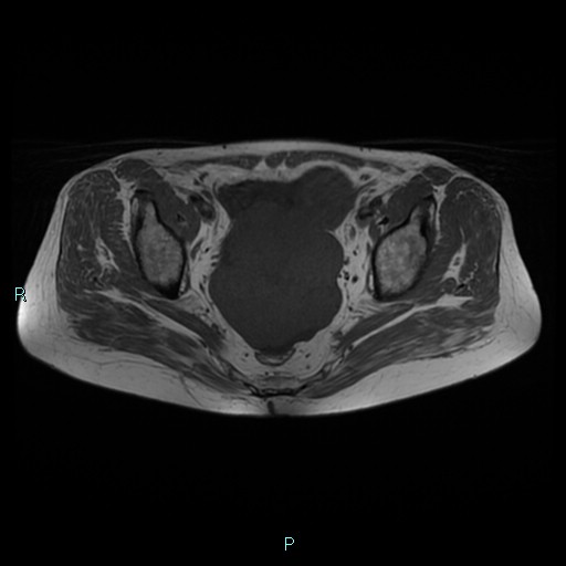 File:Bilateral ovarian fibroma (Radiopaedia 44568-48293 Axial T1 16).jpg