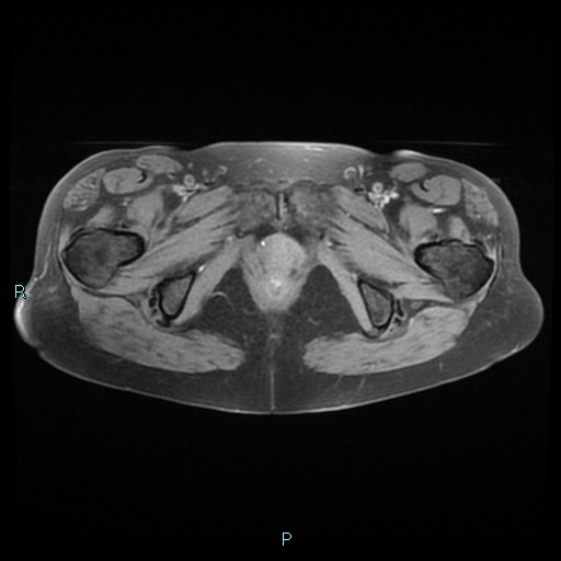 File:Bilateral ovarian fibroma (Radiopaedia 44568-48293 Axial T1 fat sat 26).jpg