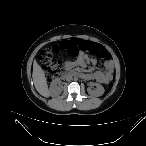 Bilateral ovarian mature cystic teratomas (Radiopaedia 79373-92457 Axial non-contrast 22).jpg