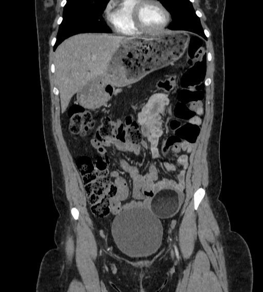 Bilateral ovarian mature cystic teratomas (Radiopaedia 79373-92457 B 12).jpg