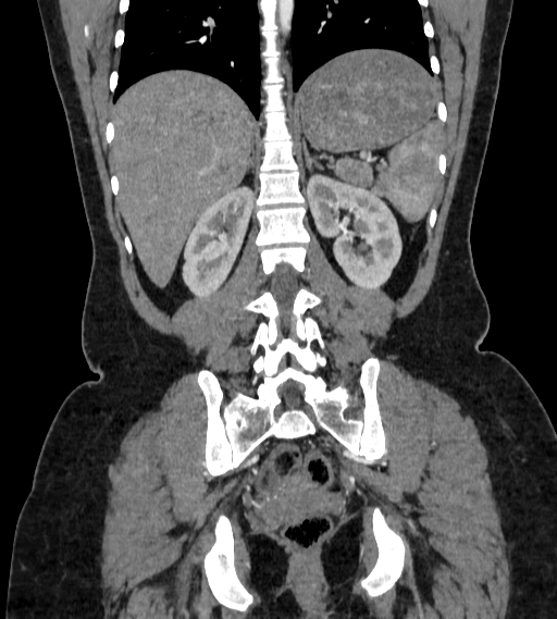 Bilateral ovarian mature cystic teratomas (Radiopaedia 79373-92457 B 67).jpg