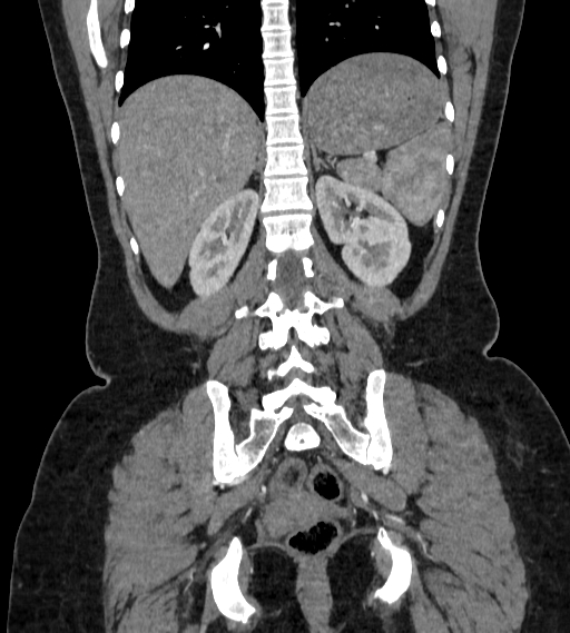 Bilateral ovarian mature cystic teratomas (Radiopaedia 79373-92457 B 69).jpg