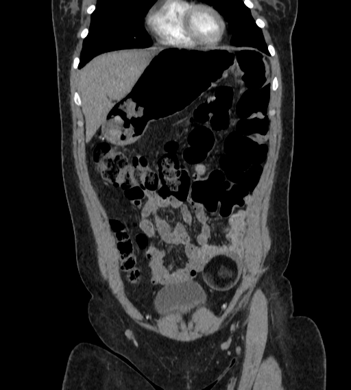 Bilateral ovarian mature cystic teratomas (Radiopaedia 79373-92457 B 8).jpg