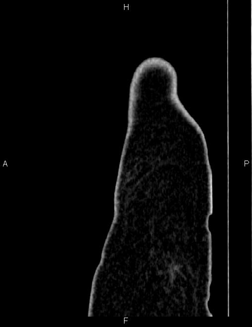 Bilateral ovarian teratoma (Radiopaedia 83131-97503 D 7).jpg
