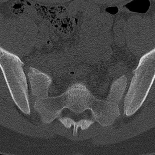 Bilateral pars defect (Radiopaedia 26691-26846 Axial bone window 100).jpg