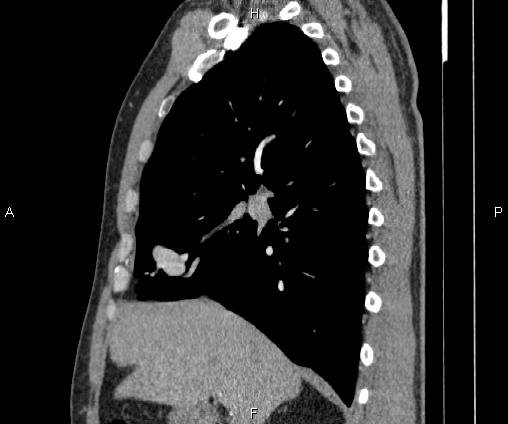 Bilateral pulmonary AVM (Radiopaedia 83134-97505 D 46).jpg