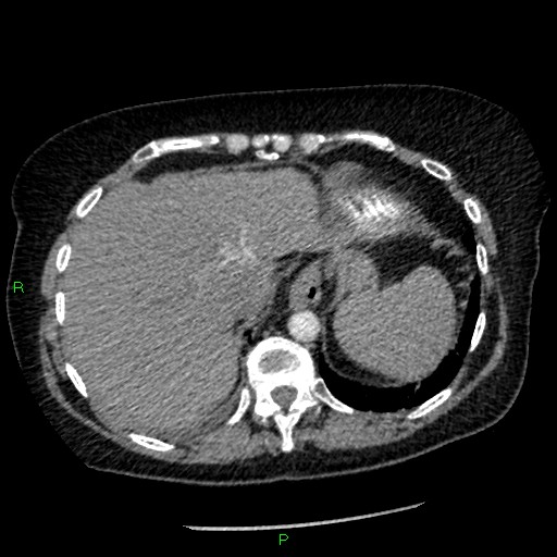 Bilateral pulmonary emboli (Radiopaedia 32700-33669 Axial C+ CTPA 94).jpg