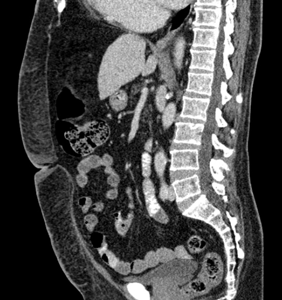Bilateral rectus sheath hematomas (Radiopaedia 50778-56252 B 41).jpg