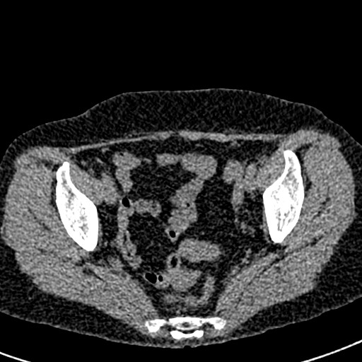 Bilateral staghorn calculi (Radiopaedia 59475-66842 Axial non-contrast 72).jpg
