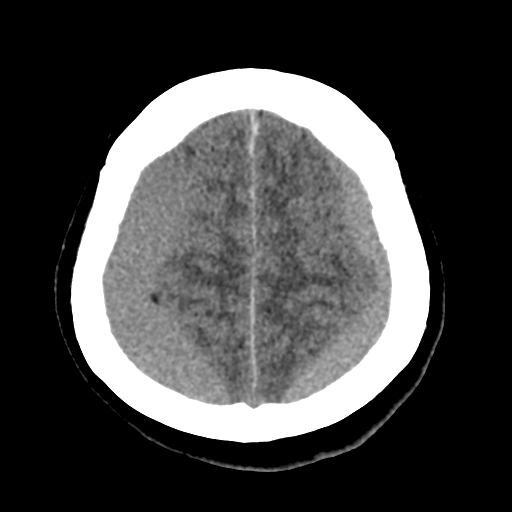 Bilateral subacute subdural hematoma (Radiopaedia 69240-79018 Axial non-contrast 41).jpg