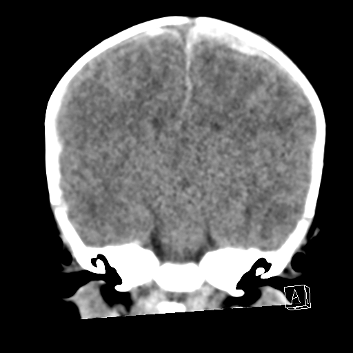 File:Bilateral subdural hemorrhage and parietal skull fracture (Radiopaedia 26058-26192 Coronal non-contrast 15).png