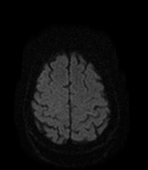 File:Bilateral thalamic glioma (Radiopaedia 65852-75009 Axial DWI 17).jpg