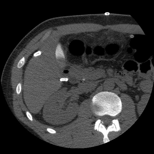 Bile leak from liver traumatic laceration (Radiopaedia 63463-72077 Axial Biliscopin 58).jpg