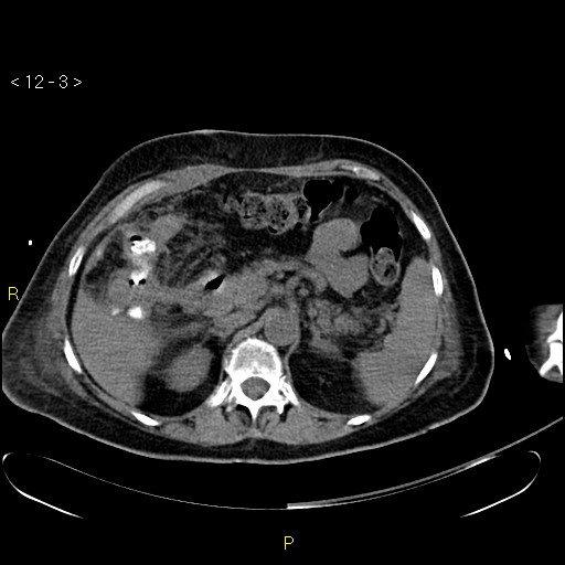 File:Biloma with drainage into the colon (Radiopaedia 20032-20068 B 12).jpg